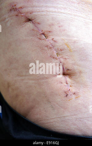 Scar following surgery of hip joint. Replacing of the devastated hip ...