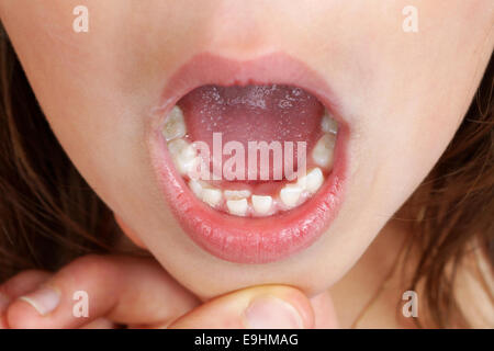 Kid with permanent tooth, bottom incisor, growing and pushing baby tooth out Stock Photo