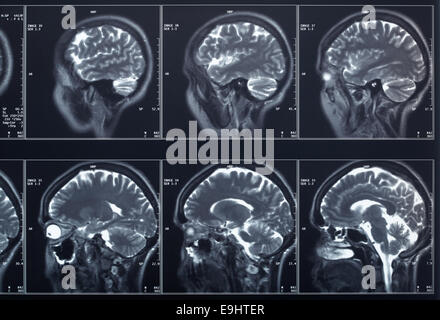 X-ray head and brain radiography Stock Photo