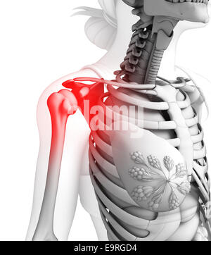 Illustration of shoulder pain artwork Stock Photo