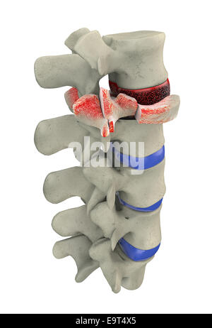 3d illustration of part of human spine, traumatic vertebral fracture, burst fracture Stock Photo