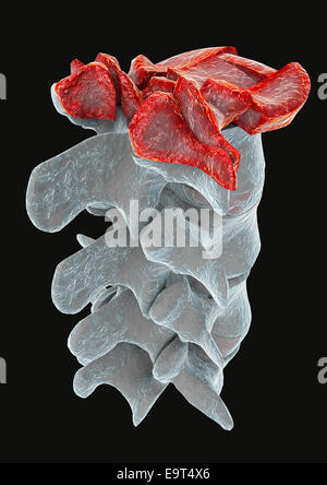 3d illustration of part of human spine, traumatic vertebral fracture, burst fracture Stock Photo