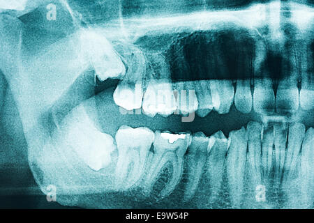 film with X-ray image of human teeth with dental pin close up isolated ...