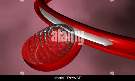 Aneurysm and endovascular treatment, spiral Stock Photo