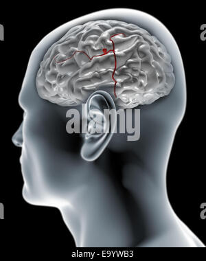 Head in profile to the x-ray with brain aneurysm Stock Photo
