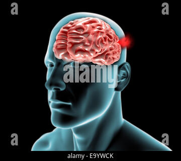Head in profile to the x-ray with brain aneurysm Stock Photo