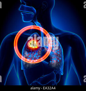 Lung Cancer - Tumor detail Stock Photo