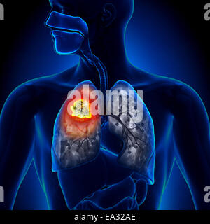 Lung Cancer - Tumor detail Stock Photo