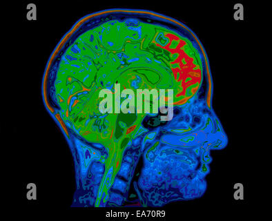 MRI Image Of Head Showing Brain Stock Photo