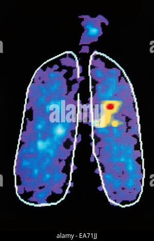 Graphic Image Showing Diesease In Human Lung Stock Photo