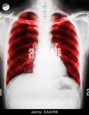 A chest x-ray of a patient with lung cancer showing a shadow on the ...