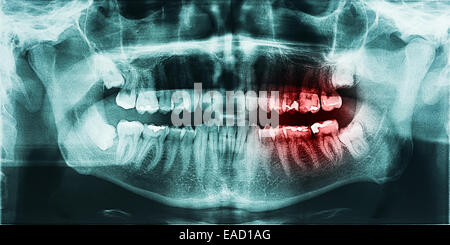 Decayed Tooth Pain On X-Ray Stock Photo