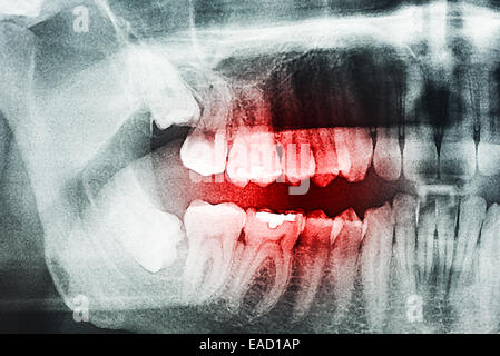 Decayed Tooth Pain On X-Ray Stock Photo