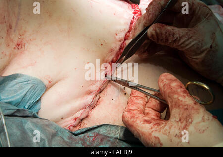 A surgeon is stitching a wound after an operation in a hospital Stock Photo