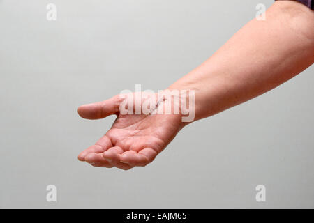 arm with stitches from carpal tunnel surgery Stock Photo
