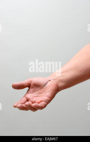 arm with stitches from carpal tunnel surgery Stock Photo