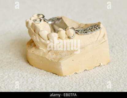 Dental metal framework for partial denture on cast model Stock Photo