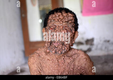 Slamet, 59, is believed to be suffering from neurofibromatosis•  Genetic condition which causes uncontrollable growths along the Stock Photo
