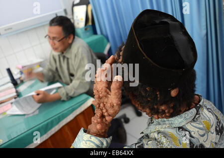 A doctor examines the patient. Slamet, 59, is believed to be suffering from neurofibromatosis. Stock Photo