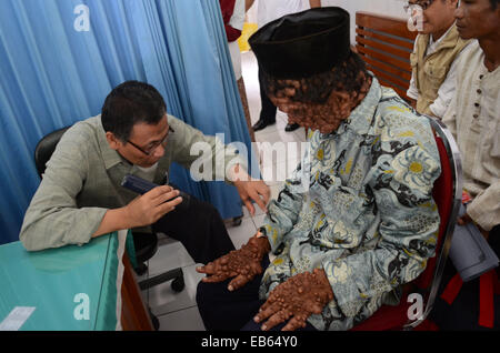 A doctor examines the patient. Slamet, 59, is believed to be suffering from neurofibromatosis. Stock Photo