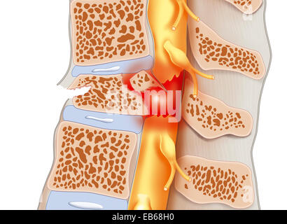 SPINAL CORD INJURY Stock Photo