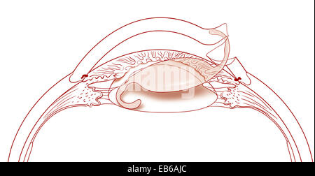 CATARACT SURGERY, DRAWING Stock Photo