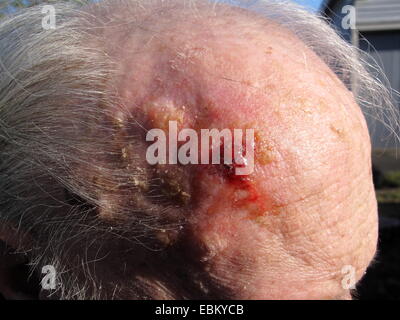 Squamous-cell carcinoma or squamous cell cancer on the head of an elderly man Stock Photo