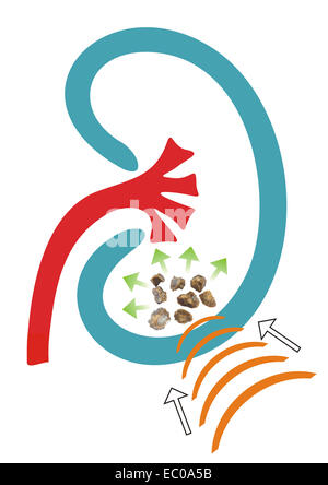 Illustration of shock waves to break up stones in the kidney,  ESWL exertions, lithotripsy Stock Photo