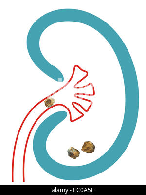 Kidney stones after ESWL intervention. Lithotripsy Stock Photo