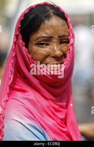 Dhaka, Bangladesh. 7th Mar, 2014. Dhaka, Bangladesh, 07th March 2014:.Survivors of acid attacks, attend a human chain to protest against acid violence on the eve of the International Women's Day celebration in Dhaka, Bangladesh. According to Acid Survivors Foundation (ASF), there had been 3,184 acid attacks since February 1999 to February 2014 in Bangladesh, where 1,792 women were victims among a total of 3,512. Acid attacks are mostly common in Cambodia, Pakistan, Afganistan, India, Bangladesh and nearby other countries. It is estimated that some 80 percent of the victims of acid attacks ar Stock Photo