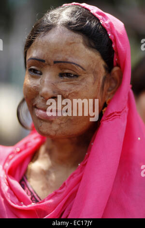 Dhaka, Bangladesh. 7th Mar, 2014. March 7, 2014 - Dhaka, Bangladesh - Dhaka, Bangladesh, 07th March 2014:.Survivors of acid attacks, attend a human chain to protest against acid violence on the eve of the International Women's Day celebration in Dhaka, Bangladesh. According to Acid Survivors Foundation (ASF), there had been 3,184 acid attacks since February 1999 to February 2014 in Bangladesh, where 1,792 women were victims among a total of 3,512. Acid attacks are mostly common in Cambodia, Pakistan, Afganistan, India, Bangladesh and nearby other countries. It is estimated that some 80 perce Stock Photo