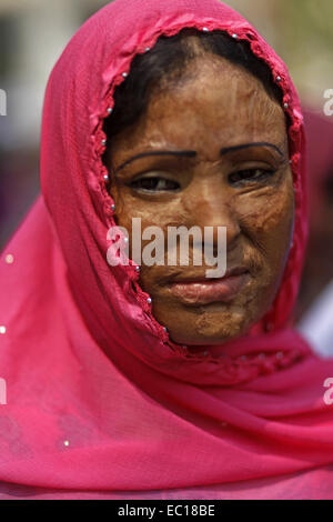 Dhaka, Bangladesh. 7th Mar, 2014. March 7, 2014 - Dhaka, Bangladesh - Dhaka, Bangladesh, 07th March 2014:.Survivors of acid attacks, attend a human chain to protest against acid violence on the eve of the International Women's Day celebration in Dhaka, Bangladesh. According to Acid Survivors Foundation (ASF), there had been 3,184 acid attacks since February 1999 to February 2014 in Bangladesh, where 1,792 women were victims among a total of 3,512. Acid attacks are mostly common in Cambodia, Pakistan, Afganistan, India, Bangladesh and nearby other countries. It is estimated that some 80 perce Stock Photo
