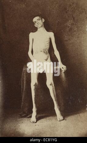 American Civil War soldier malnourished as a prisoner of war. Pvt. William M. Smith, Co. D, 8th Kentucky Vols. at U.S. General Hospital, Div. No. 1, Annapolis, Maryland, June 1, 1864 Stock Photo
