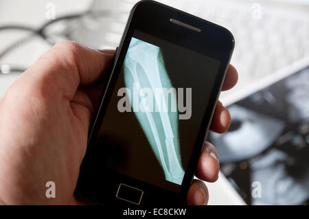 x-ray of broken leg bone on smartphone screen Stock Photo