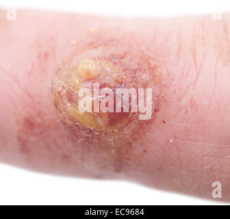 close up shot of wart on finger Stock Photo