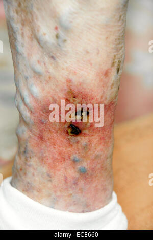 Varicose ulcers situated on a ruptured varicose vein inflamed & very painful Stock Photo