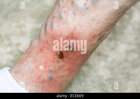 Varicose ulcers situated on a ruptured varicose vein inflamed & very painful Stock Photo