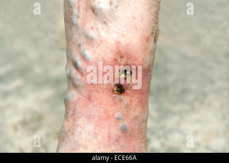 Varicose ulcers situated on a ruptured varicose vein inflamed & very painful Stock Photo