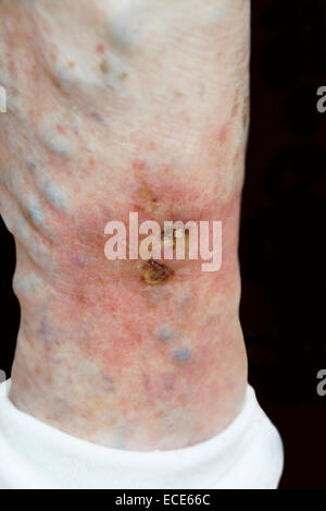 Varicose ulcers situated on a ruptured varicose vein inflamed & very ...