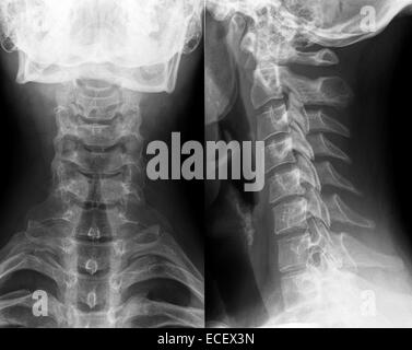 Xray of neck and cervical spine, front and side view. Stock Photo