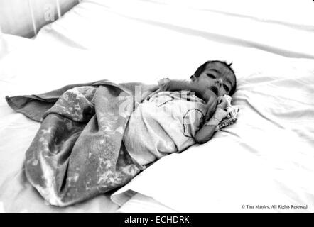 Malnourished and dehydrated baby in the Alwya Children's Hospital in Baghdad, Iraq.  More babies are suffering from diarrhea because the water treatment plant was destroyed in the Gulf War and impure water is being used in baby formulas.  The only medicine available in the hospitals of Iraq is glucose, a situation blamed on the UN Sanctions against Iraq. Stock Photo