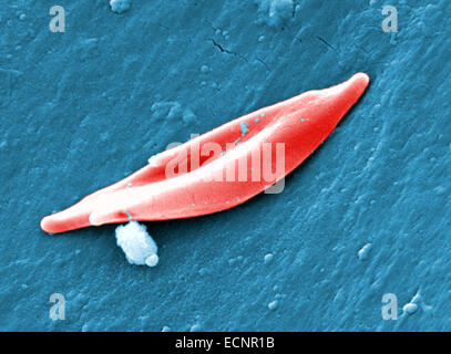 digitally-colorized scanning electron micrograph (SEM) of sickle cell red blood cell (RBC) found in a blood specimen of an 18 year old female patient with sickle cell anemia Stock Photo