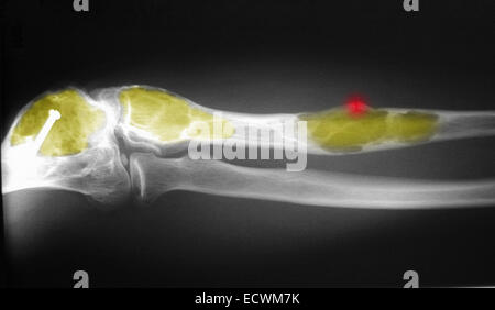 X-ray showing fibrous dysplasia of the ulna and humerus. Stock Photo