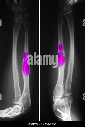 X-ray showing fibrous dysplasia of the ulna and humerus. Stock Photo