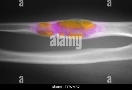 X-ray showing fibrous dysplasia of the ulna and humerus. Stock Photo