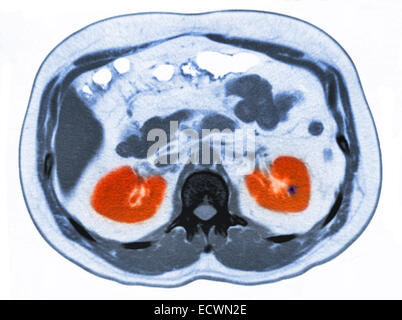 CT scan of the abdomen showing a small kidney stone. Stock Photo