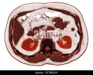 CT scan of the abdomen showing a small kidney stone. Stock Photo