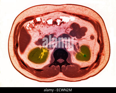 CT scan of the abdomen showing a small kidney stone. Stock Photo