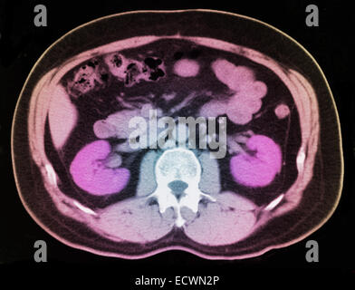 CT scan of the abdomen showing a small kidney stone. Stock Photo