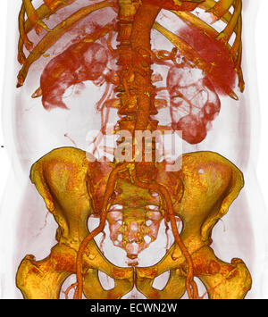 3D CT showing atherosclerotic plaque on the lower aorta. Stock Photo